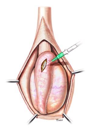 Microdissection Testicular Sperm Extraction (MicroTESE